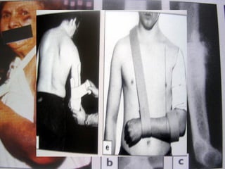 ATLS-Primary survey
F- Fracture management
1. Minor
2. Moderate open # of digits
undisplaced long bone or pelvis #
3. Serious closed long bone #s
multiple hand/foot #s
4. Severe life threatening
open long bone #
pelvis # with displacement
dislocation of major joints
multiple amputations of digits
amputation of limbs
multiple closed long bone #s
 