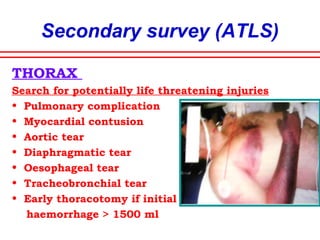 Secondary survey (ATLS)
NECK
• Subcut emphysema
• Cervical spine
fractures
(specially C1,C2,C7)
• Penetrating neck
injuries
 