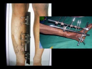 OPEN FRACTURE
DISLOCATION
AROUND THE ELBOW
 