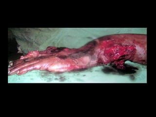 Secondary survey ( ATLS )
EXTREMITIES
Mangled Extremity Severity Score ( MESS )
based upon –
1. Skeletal / Soft tissue group
2. Shock group
3. Ischaemia group
4. Age group
If > 7, limb salvage is questionable
 