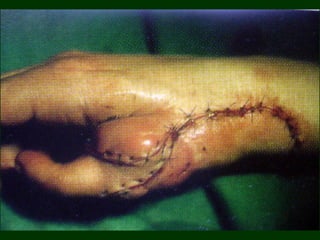 Definitive care plan(ATLS)
Multi-speciality approach
( Inter-disciplinary
management )
The most appropriate person in-
charge
is the General / Orthopaedic
surgeon.
 