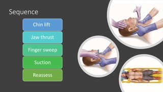 Sequence
Chin lift
Jaw thrust
Finger sweep
Suction
Reassess
 