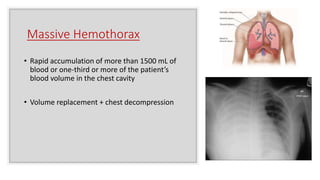 Massive Hemothorax
• Rapid accumulation of more than 1500 mL of
blood or one-third or more of the patient’s
blood volume in the chest cavity
• Volume replacement + chest decompression
 