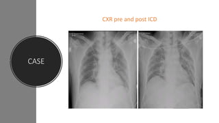 CASE
CXR pre and post ICD
 