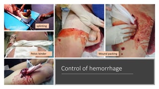 Control of hemorrhage
Wound packingPelvic binder
splinting
 