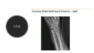 CASE
Fracture Distal both bone forearm – right
 