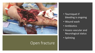 Open fracture
• Tourniquet if
bleeding is ongoing
• Wound wash
• Antibiotics
• Assess vascular and
Neurological status
• Splinting
 