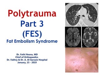 Dr. Fathi Neana, MD
Chief of Orthopaedics
Dr. Fakhry & Dr. A. Al-Garzaie Hospital
January, 15 - 2019
Polytrauma
Part 3
(FES)
Fat Embolism Syndrome
 