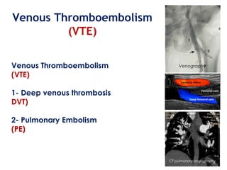 Vte Rotherham Polytrauma part 5 (VTE) | PPT