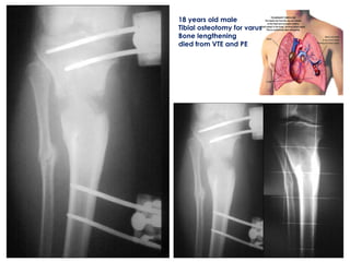 18 years old male
Tibial osteotomy for varus
Bone lengthening
died from VTE and PE
 