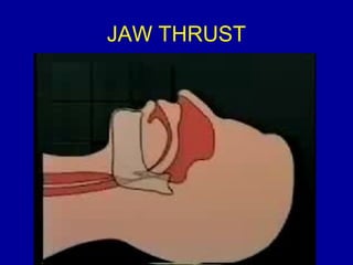 JAW THRUST 
 
