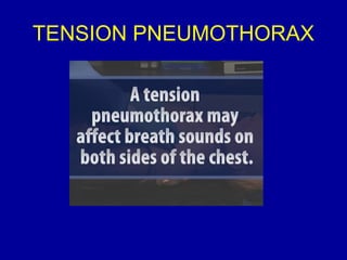 TENSION PNEUMOTHORAX 
 