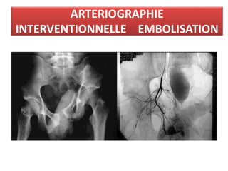 ARTERIOGRAPHIE
INTERVENTIONNELLE EMBOLISATION
 