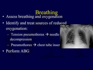 Breathing
• Assess breathing and oxygenation
• Identify and treat sources of reduced
oxygenation:
– Tension pneumothorax  needle
decompression
– Pneumothorax  chest tube insertion
• Perform ABG
 
