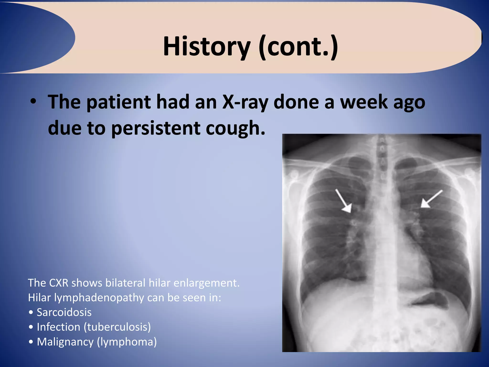 History (cont.)
• The patient had an X-ray done a week ago
due to persistent cough.
The CXR shows bilateral hilar enlargement.
Hilar lymphadenopathy can be seen in:
• Sarcoidosis
• Infection (tuberculosis)
• Malignancy (lymphoma)
 