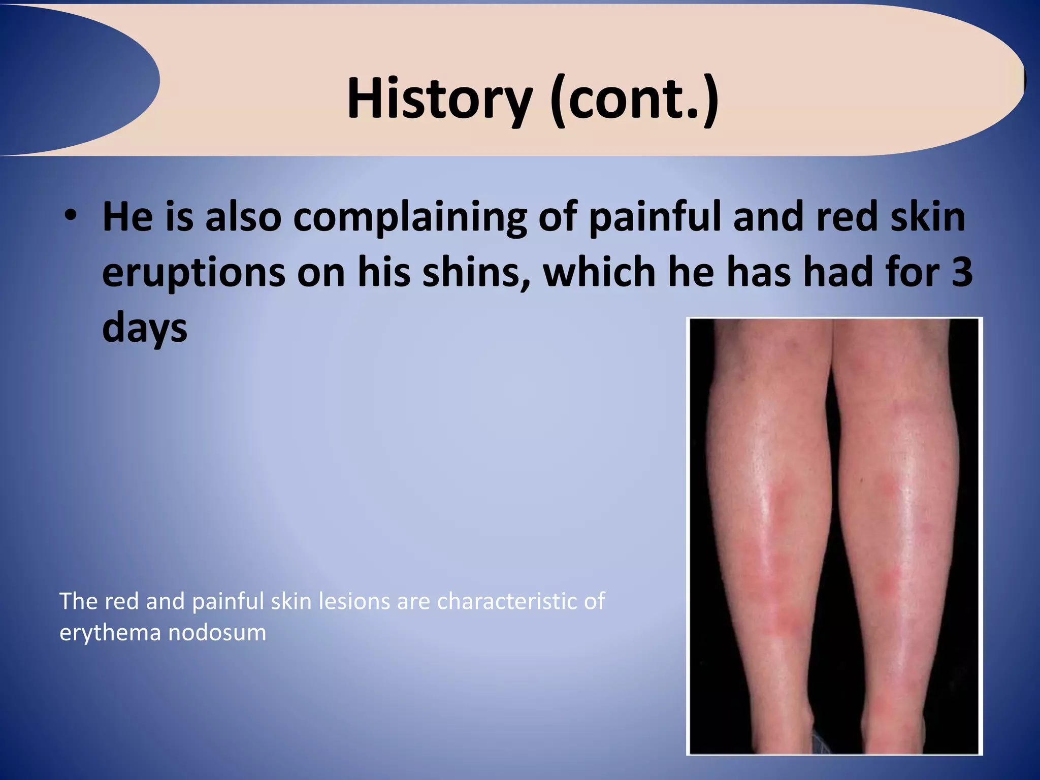 History (cont.)
• He is also complaining of painful and red skin
eruptions on his shins, which he has had for 3
days
The red and painful skin lesions are characteristic of
erythema nodosum
 