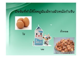 ปจจัยที่ทําใหโรคภูมิแพทางผิวหนังกําเริบ



                               ถั่วทอด
     ไข



                  นม
 