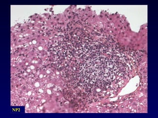 NP2 NP2 