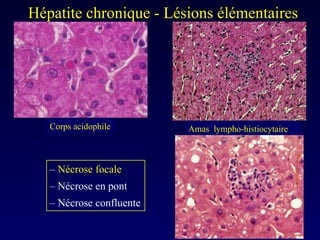 Hépatite chronique - Lésions élémentaires  Corps acidophile Amas  lympho-histiocytaire –  Nécrose focale –  Nécrose en pont –  Nécrose confluente 