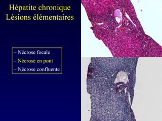 Hépatite chronique  Lésions élémentaires  –  Nécrose focale –  Nécrose en pont –  Nécrose confluente 