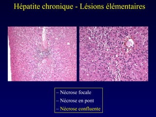 Hépatite chronique - Lésions élémentaires  –  Nécrose focale –  Nécrose en pont –  Nécrose confluente 