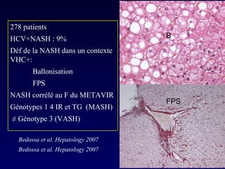 Bedossa et al. Hepatology 2007 Bedossa et al. Hepatology 2007 278 patients  HCV+NASH : 9% Déf de la NASH dans un contexte VHC+: Ballonisation FPS NASH corrélé au F du METAVIR Génotypes 1 4 IR et TG  (MASH) ≠  Génotype 3 (VASH) FPS B 
