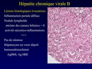 Lésions histologiques évocatrices Inflammation portale diffuse  Nodule lymphoïde atteinte des canaux biliaires = 0  activité nécrotico-inflammatoire +++ Pas de stéatose Hépatocytes en verre dépoli Immunohistochimie  AgHbS, Ag HbE Hépatite chronique virale B  