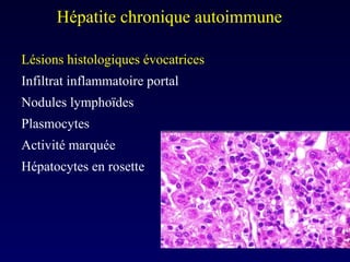 Lésions histologiques évocatrices Infiltrat inflammatoire portal Nodules lymphoïdes Plasmocytes Activité marquée Hépatocytes en rosette Hépatite chronique autoimmune  
