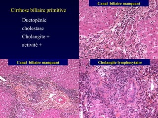 Ductopénie  cholestase Cholangite + activité + Cirrhose biliaire primitive Canal  biliaire manquant Canal  biliaire manquant Cholangite lymphocytaire 