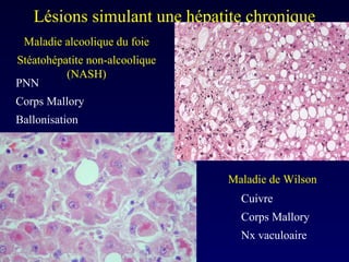 Lésions simulant une hépatite chronique Cuivre  Corps Mallory  Nx vaculoaire PNN  Corps Mallory  Ballonisation  Maladie alcoolique du foie Stéatohépatite non-alcoolique (NASH) Maladie de Wilson 