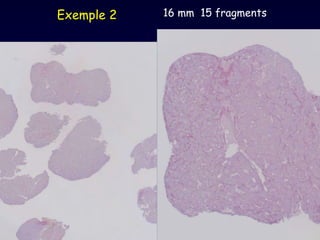 16 mm  15 fragments   Exemple 2 