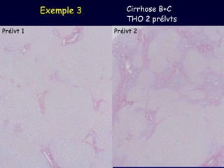 Exemple 3 Cirrhose B+C THO 2 prélvts  Prélvt 1  Prélvt 2  