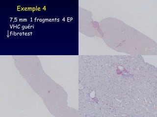 7,5 mm  1 fragments   4 EP VHC guéri fibrotest Exemple 4 