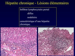 Infiltrat lymphocytaire portal diffus nodulaire caractéristique d’une hépatite chronique. Hépatite chronique - Lésions élémentaires  