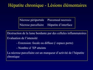Destruction de la lame bordante par des cellules inflammatoires Evaluation de l’intensité - Extension: focale ou diffuse (/ espace porte) - Nombre d ’EP atteints La nécrose parcellaire est un marqueur d’activité de l’hépatite chronique Nécrose périportale Piecemeal necrosis Nécrose parcellaire Hépatite d’interface Hépatite chronique - Lésions élémentaires  