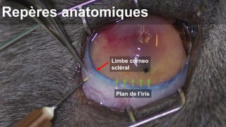 Repères anatomiques 
Limbe corneo 
scléral 
Plan de l’iris 
 