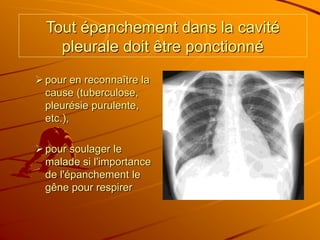 Tout épanchement dans la cavité
pleurale doit être ponctionné
pour en reconnaître la
cause (tuberculose,
pleurésie purulente,
etc.),
pour soulager le
malade si l'importance
de l'épanchement le
gêne pour respirer
 