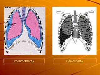 Pneumothorax Hémothorax
 