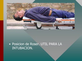• Posicion de Roser. UTIL PARA LA
INTUBACION.
 