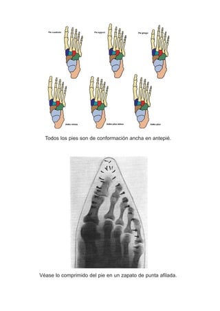 Todos los pies son de conformación ancha en antepié.
Véase lo comprimido del pie en un zapato de punta afilada.
 