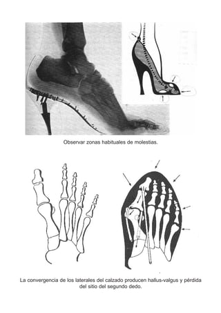 Observar zonas habituales de molestias.
La convergencia de los laterales del calzado producen hallus-valgus y pérdida
del sitio del segundo dedo.
 