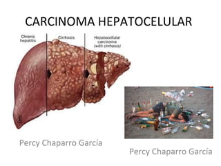 CARCINOMA HEPATOCELULAR
Percy Chaparro García
Percy Chaparro García
 