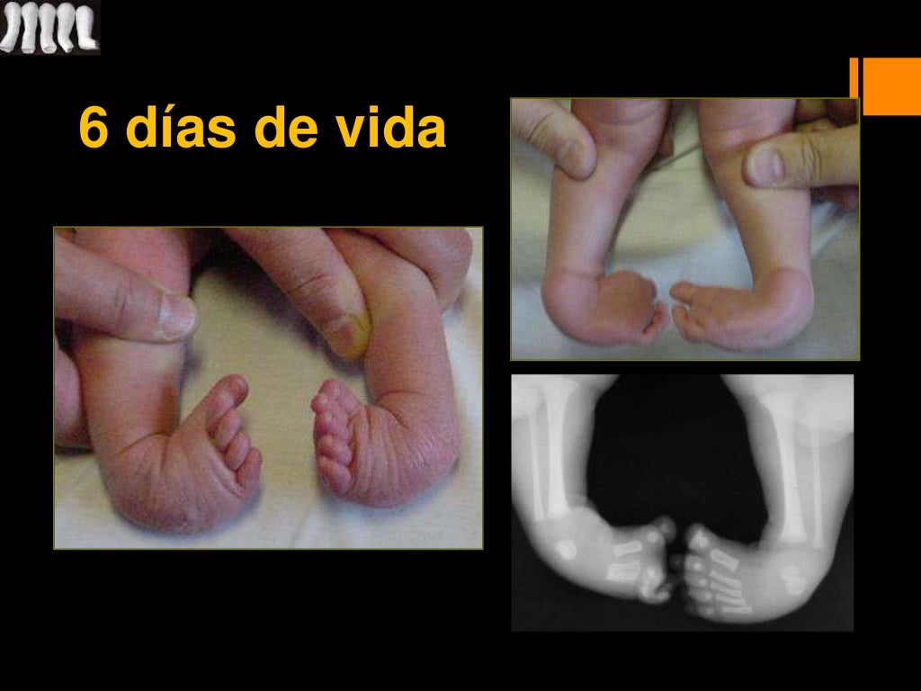 Ponseti; Pie equino varo; PEVC