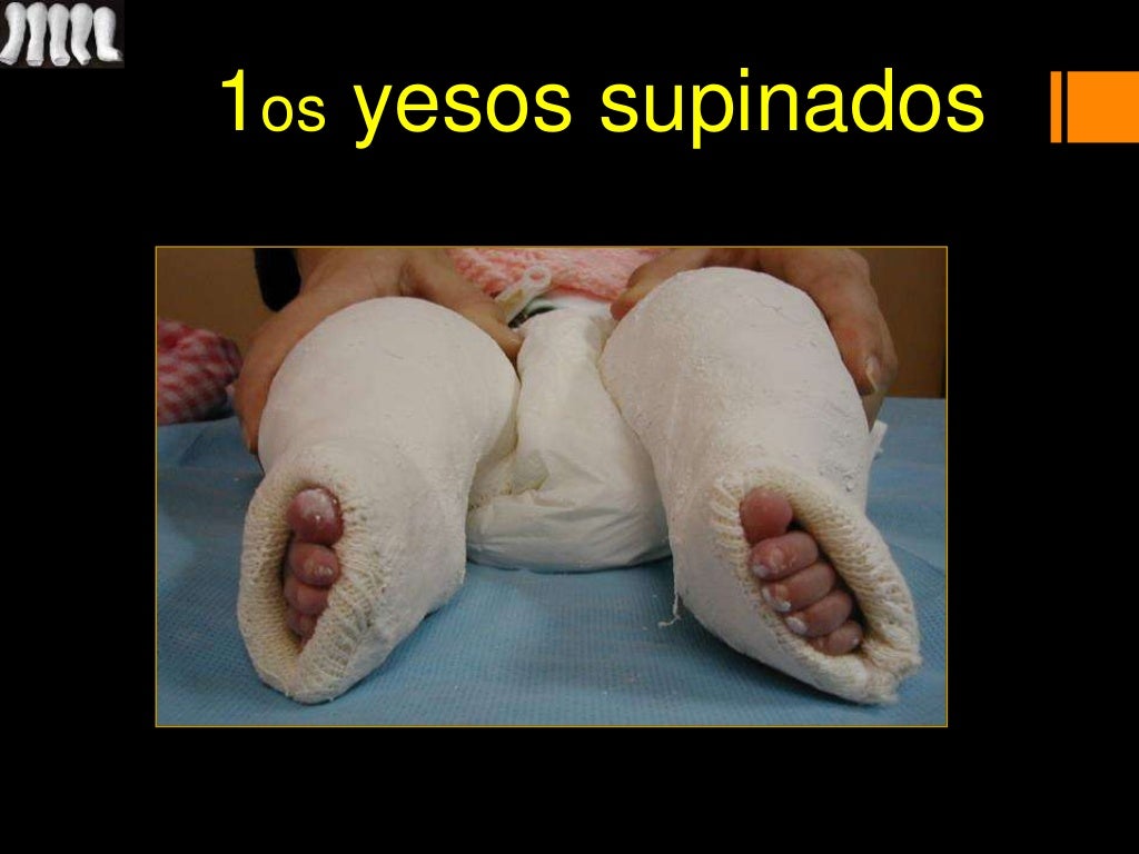 Ponseti; Pie equino varo; PEVC