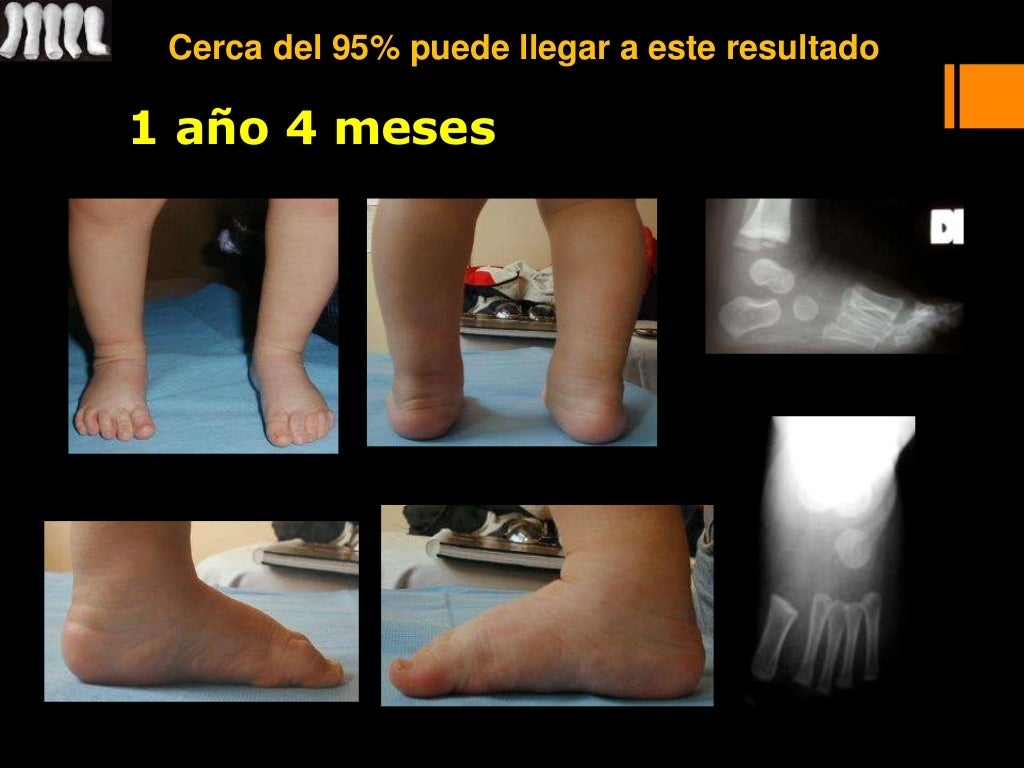 Ponseti; Pie equino varo; PEVC