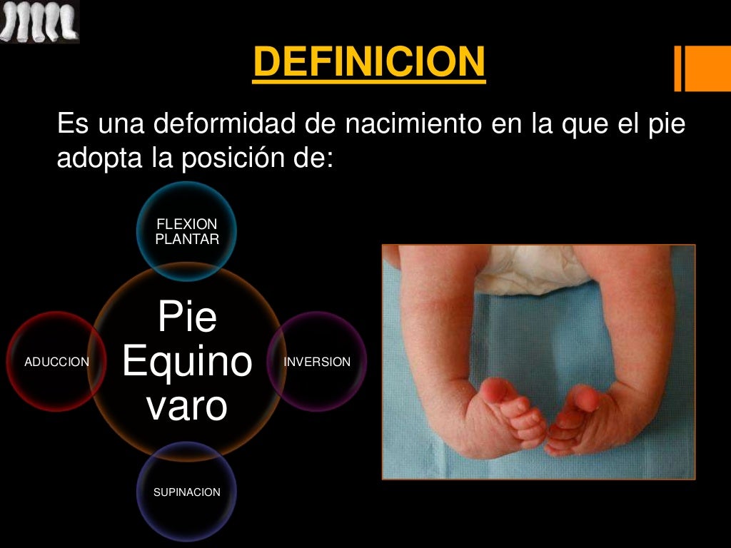 Ponseti; Pie equino varo; PEVC