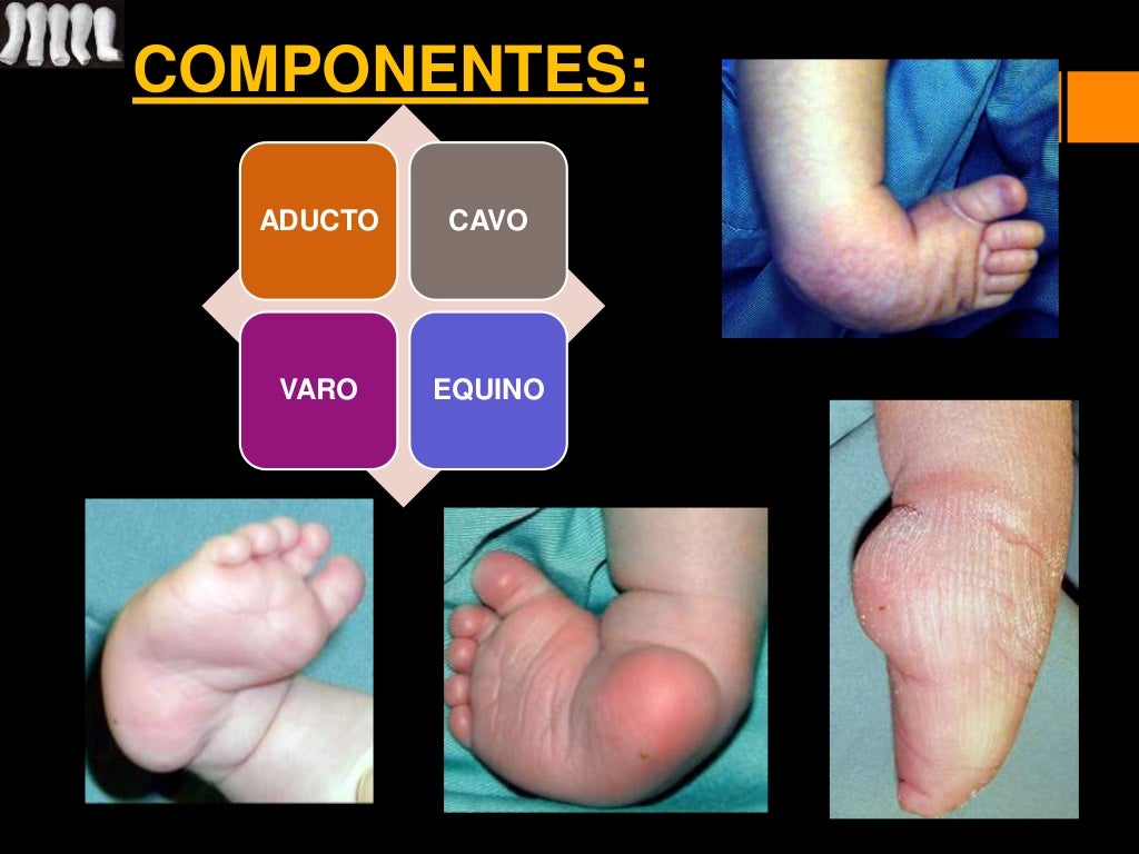 Ponseti; Pie equino varo; PEVC