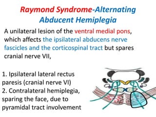 Raymond Syndrome-Alternating
Abducent Hemiplegia
A unilateral lesion of the ventral medial pons,
which affects the ipsilateral abducens nerve
fascicles and the corticospinal tract but spares
cranial nerve VII,
1. Ipsilateral lateral rectus
paresis (cranial nerve VI)
2. Contralateral hemiplegia,
sparing the face, due to
pyramidal tract involvement
 