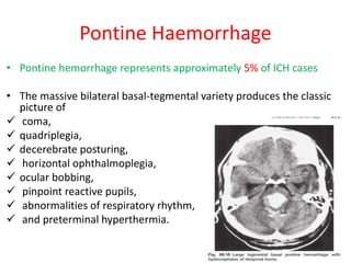 Pontine Haemorrhage
• Pontine hemorrhage represents approximately 5% of ICH cases
• The massive bilateral basal-tegmental variety produces the classic
picture of
 coma,
 quadriplegia,
 decerebrate posturing,
 horizontal ophthalmoplegia,
 ocular bobbing,
 pinpoint reactive pupils,
 abnormalities of respiratory rhythm,
 and preterminal hyperthermia.
 