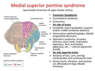Medial Pontine Syndrome